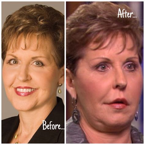 Joyce Meyer’s Face: The Plastic Surgery Reports | herinterest.com/