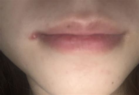cold sore or pimple? : r/Coldsore