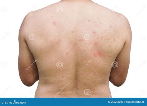 Picture of a Patient with Eczema, Ringworm on the Skin of the Back.Medical Healthcare and ...