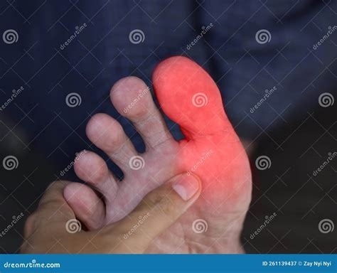 Inflammation in the Big Toe. Concept of Foot Joint Pain, Arthritis, Stumble, Hyperuricema or ...