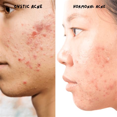 Hormonal Cystic Pimple