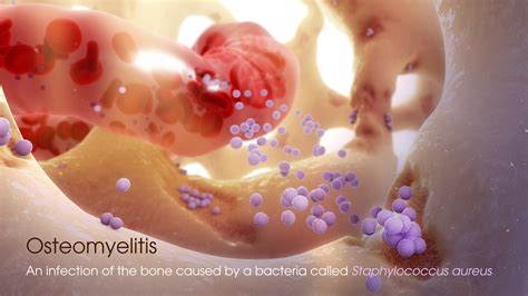 Osteomyelitis Of Jaw Bone at Bruce Huggins blog