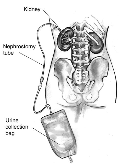 Life Expectancy With Nephrostomy Tubes