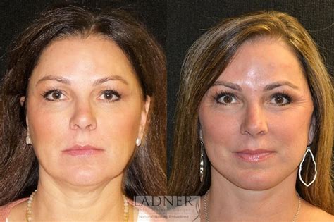 Deep Plane Facelift / Neck Lift Before and After Pictures Case 29 | Denver, CO | Ladner Facial ...