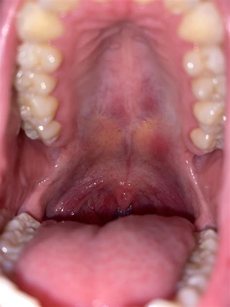 Possible reason for red bumps on roof of mouth : r/askdentists