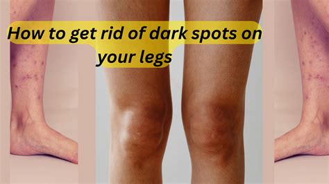 How to Get Rid of Dark Spots on Your Legs - Elite Vascular & Wellness | New Jersey's Trusted ...