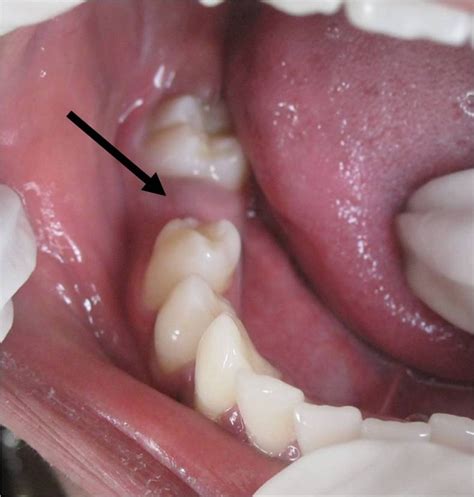 Dentigerous cyst: a common lesion in an uncommon site | BMJ Case Reports