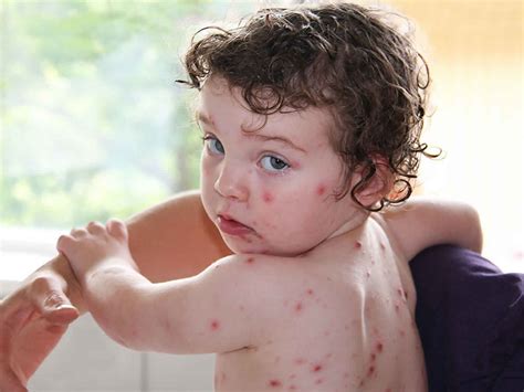 Varicella, chicken pox, causes, signs, symptoms, rash, diagnosis & treatment