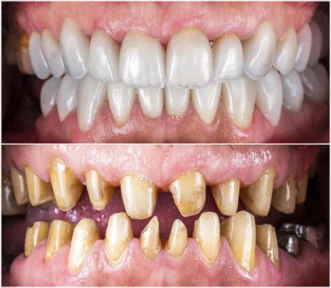 Veneers Process