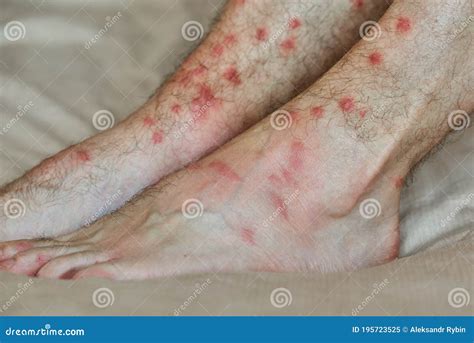 Male Feet with Many Red Spot and Scar from Insect Bite. Severe ...