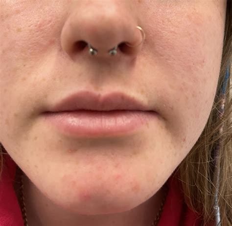 Lip Piercing Scar