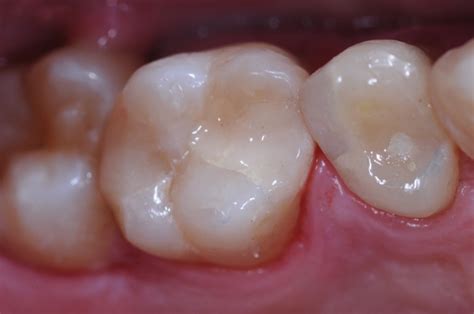 Dental Update - Fifty years of glass ionomers (GICs). Are the latest GICs suitable for restoring ...