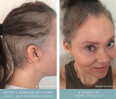 Chemotherapy Hair Lash Brow Loss Before + After Photos