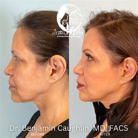 PERIORAL MOUND TREATMENT BEFORE & AFTER GALLERY