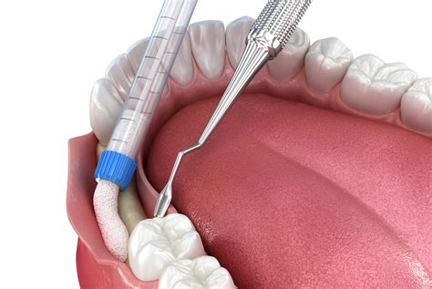 Gum Grafts: Understanding the Procedure