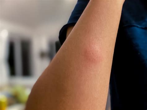 Gnat Bites: Symptoms, Causes, Treatment, and More