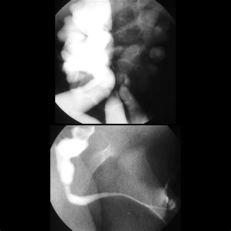 Posterior Urethral Valves | Pediatric Radiology Reference Article ...