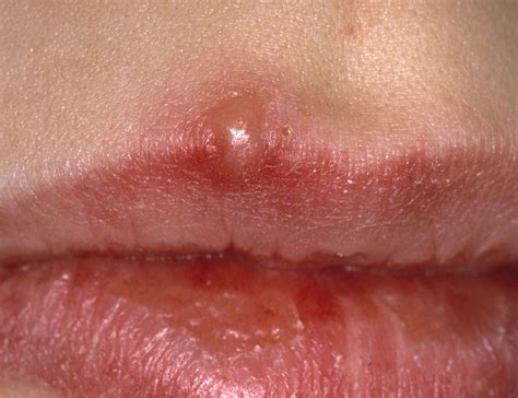 What Causes Blisters On Inside Of Lips | Lipstutorial.org