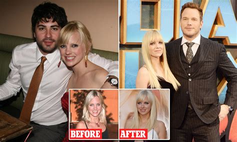 Anna Faris Face Surgery