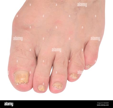 White Toenail Fungus