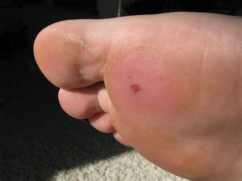 Developing holes in my feet | The Barefoot Weave