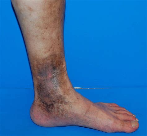 If you have leg wounds that are difficult to heal, you should suspect varicose veins. | The ...