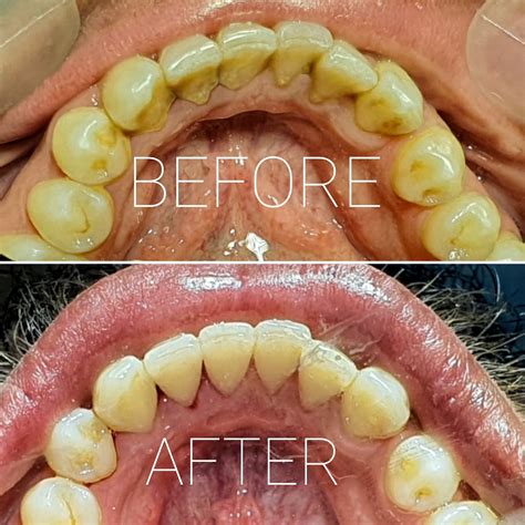 Scaling and Polishing - Durrani’s Dental Clinic | Dental Cleaning.