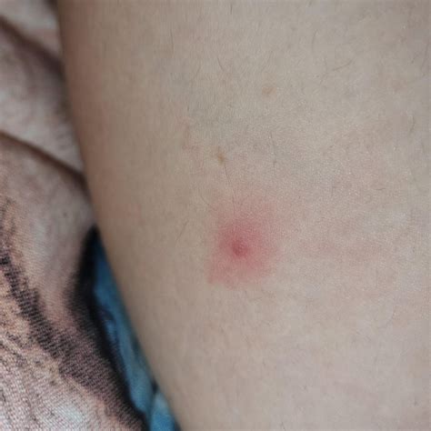painful pimples on legs, they are full of white and are very red around ...