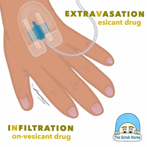 How to tell the difference between Extravasation and Infiltration ...