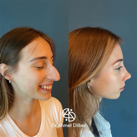 Rhinoplasty Result - Dr. Ahmet Dilber | Rhinoplasty before and after, Nose job, Nose plastic surgery