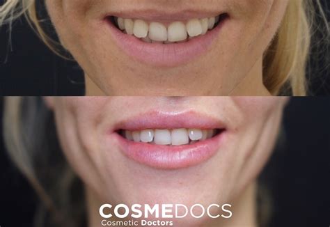 Realistic 1Ml Lip Filler before And After Thin Lips: Stunning ...