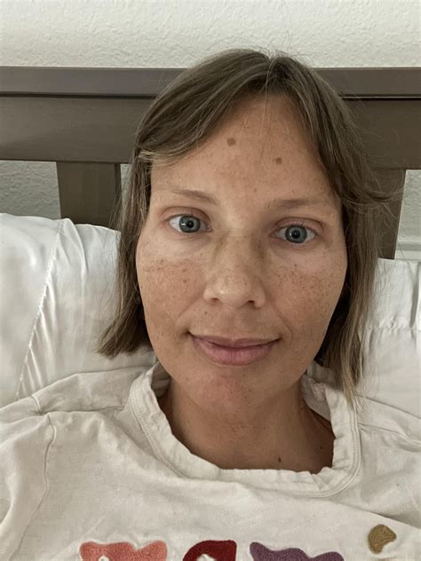 Addison Disease Addison Disease (Hypoadrenocorticism) Wellness