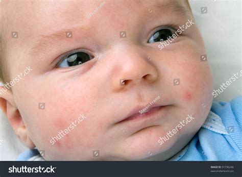 Red Rash Baby Chest And Back at Jonathan Dittmer blog