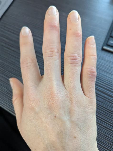 Knuckle Inflammation and Joint Pain : r/DiagnoseMe