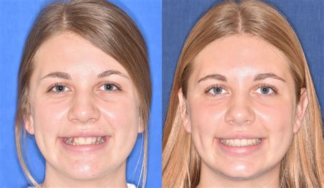 Before & Afters | Parks, Schmit & Fuller Orthodontics