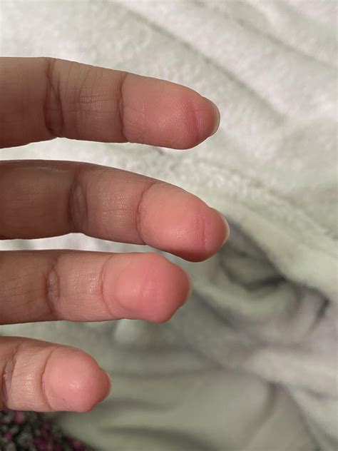 hi guys, how long will it take before calluses develop? I started yesterday and I will play at ...