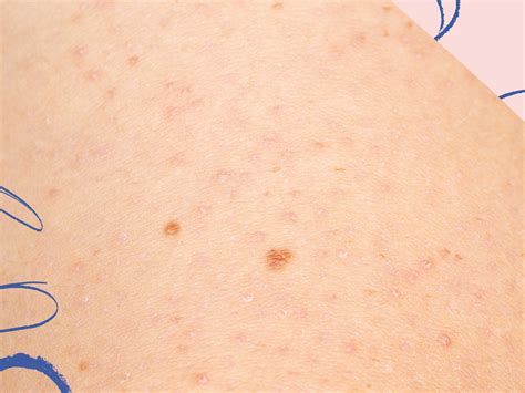 How To Avoid Chicken Skin - Heightcounter5