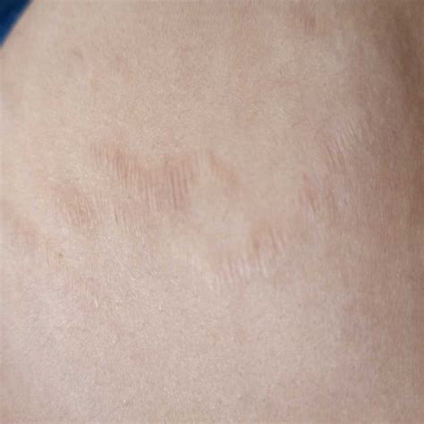 #AskTheExpert #StretchMarks How to remove stretch marks after 1year of ...