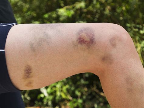 Can Bruises Be A Sign Of Blood Clots at Marcos Hines blog