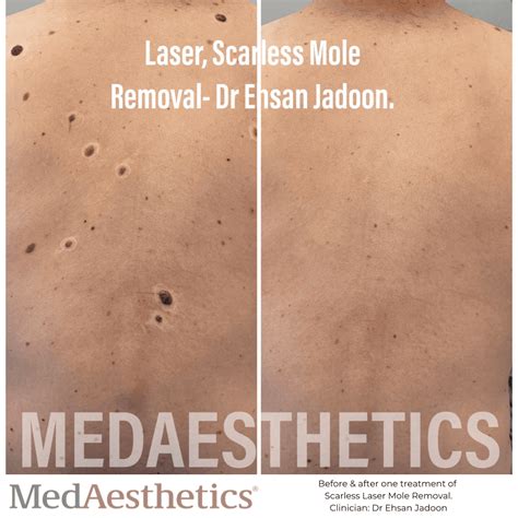 Laser Surgery For Moles