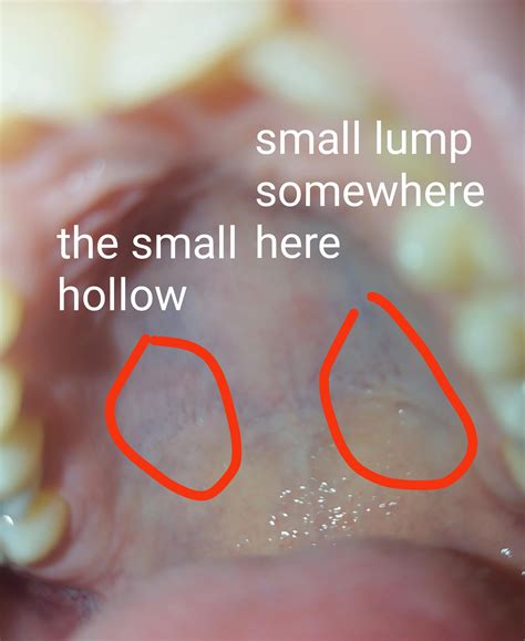 Small lump on the roof od the mouth : r/DiagnoseMe