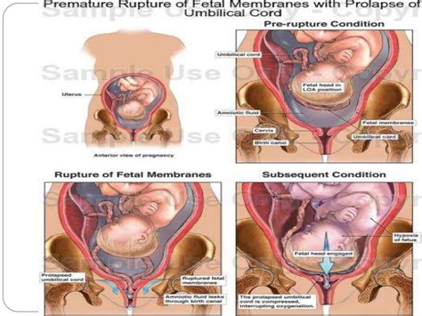 premature-rupture-of- membranes by hasan mbbs .pptx