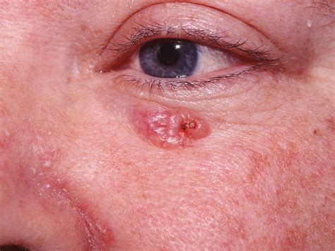 Basal Cell Carcinoma Beginning at Julius Peterkin blog