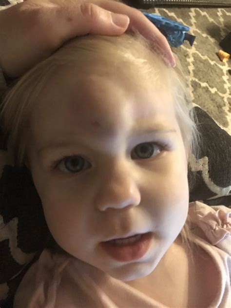 Head Injury Goose Egg