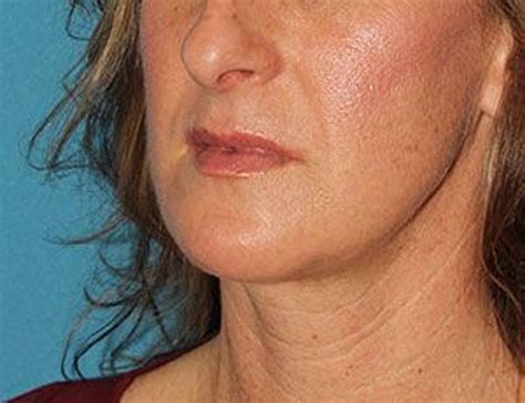 Chin Reduction Before & After Photos in Houston, TX | Face Forward