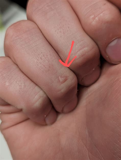 Concerning growth on finger near knuckle : r/Melanoma
