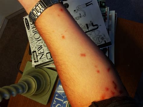 8 Photos Carpet Beetle Bites In A Row And Description - Alqu Blog