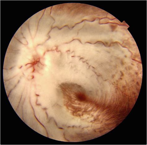 Myelinated Nerve Fiber