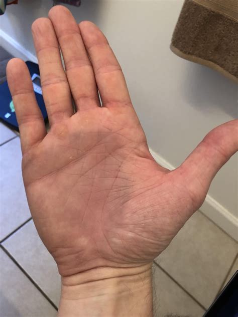 I busted some blood vessels in my hand and all the blood pooled under my palm : r/mildlyinteresting
