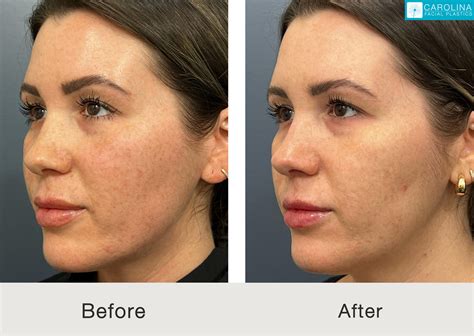 BBL Hero Before and After for Brighter Skin - Carolina Facial Plastics